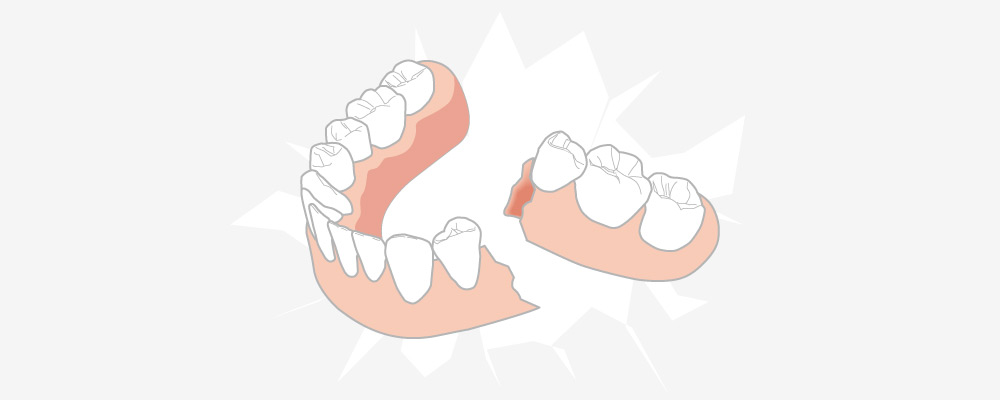 リオ歯科クリニカの入れ歯が壊れた場合の対処法解説
